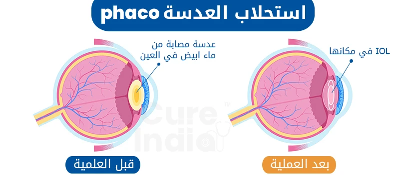 عملية استحلاب العدسة في الهند
